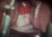 Trichomonas vaginalis Diagnos: Inspektion, direktmikroskopi (odling) Beh: Flagyl (+partnerbehandling) https://www.youtube.com/watch?