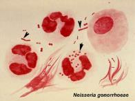 Obehandlad klamydia ger risk för: endometrit (smärtor, mellanblödningar), salpingit ärrvävnad i äggledarna kan ge stopp > infertilitet bitestikel- eller prostatainflammation -kan sprida sig till