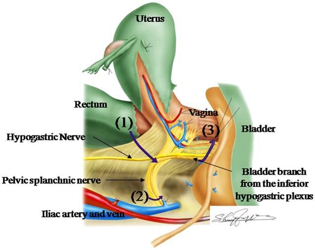 Nervsparande kirurgi Nerver av betydelse: Plexus hypogastricus sup