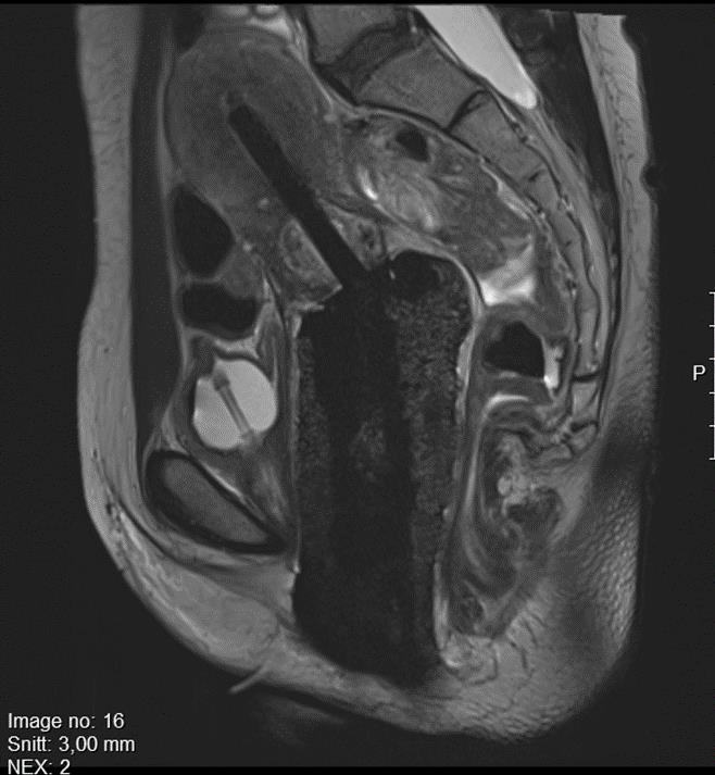 MR-planerad individualiserad brachybehandling (3D) Spinalanestesi, applikatorer och av nålar placeras MR