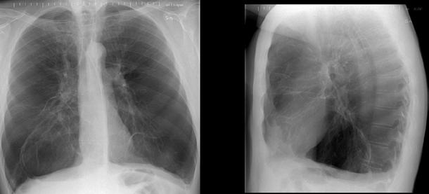 2013:59 Endobronchial lung volume reduction in patients with severe chronic obstructive pulmonary disease L eder reduktion av lungvolym med endobronkiella ventiler till en förbättrad livskvalitet och