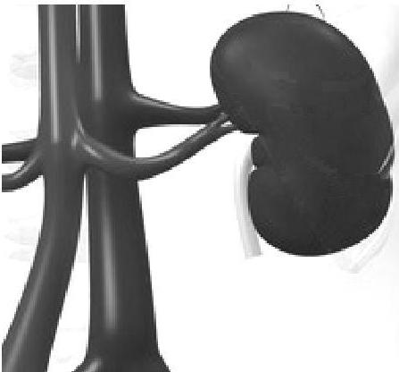 2013:57 Cytoreduktiv kirurgi med intraperitoneal cytostatika vid kolorektalt adenocarcinom och peritoneal carcinos.