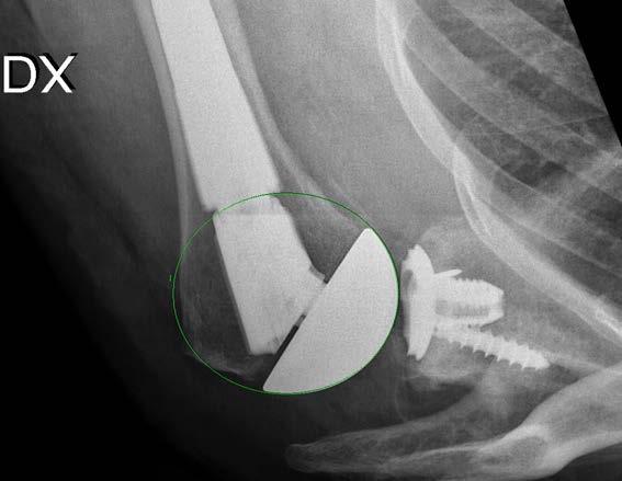 vetenskapligt underlag, (GRADE ) Underlag saknades för att bedöma effekter vid latent tuberkulos 2012:52 Skulderledsprotes vid artros F örbättras funktion och livskvalitet hos patienter med