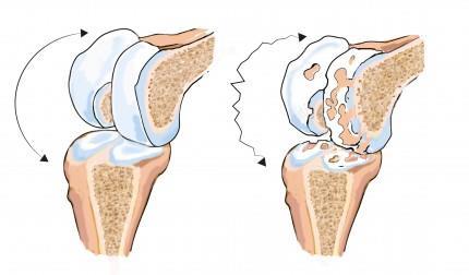 Total eller partiell knäplastik rekommenderas främst för grad 4-skador.