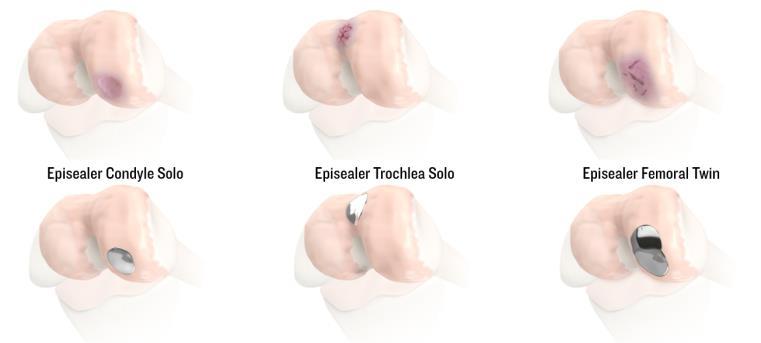 De tre implantaten är CE-godkända och täcker de flesta broskskador på lårbenet i knäleden för