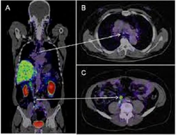 68-Ga PSMA PET-CT Kombination av isotop och CT En ny och