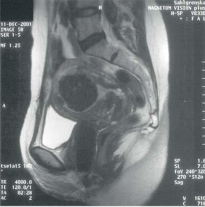 Figur 2. T2-viktad sagittal magnetkamerabild visar förstorad uterus med ett lågsignalerande submuköst myom (pil) i fundus. Figur 3.