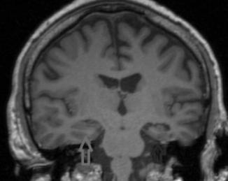 limbisk encefalit (Vincent, 2010) Case