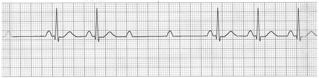 EKG rytmtolkning: Annika Hickisch Fråga 1 En man, Bertil, 55 års ålder söker på akuten för att han de senaste timmarna känt av yrsel och ibland näst intill svimfärdig.