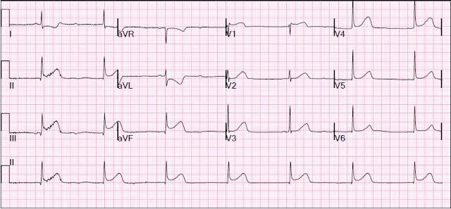 EKG Ischemi analys: Annika Hickisch Fråga 2. En 65 årig kvinna, Diana, kommer in på akutmottagningen med diffus smärta i övre delen av buken samt tryckkänsla över bröstkorgen.