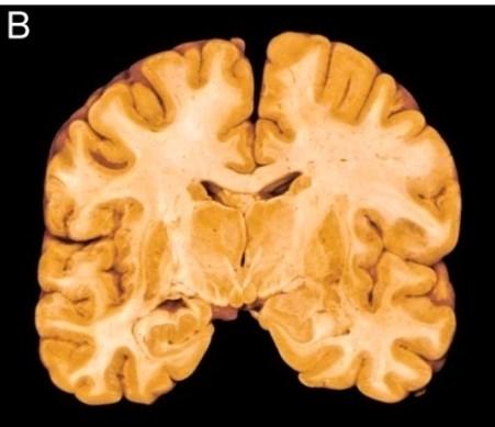 Försämringen över tid vid Alzheimers sjukdom, stadieindelningen bygger på