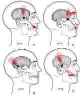 MalmstromEM, Karlberg M, MelanderA, Magnusson M, Moritz U. Cervicogenic dizziness musculoskeletal findings before and after treatment and long-term outcome. Disabil Rehabil. 2007;29(15):1193-205.