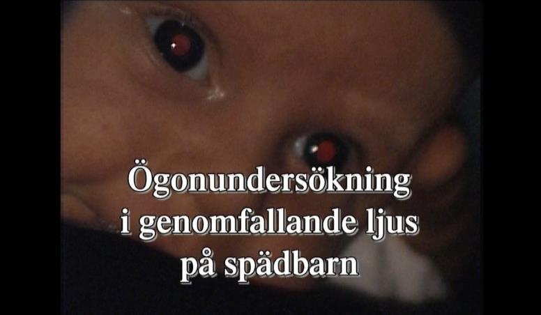 Undersökning av röd reflex http://lioappl1.lio.se/video/2011/ogonundersokning_svensk.