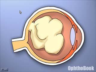 Retinoblastom Utsläckt eller grå reflex Mycket ovanlig efter 5 års ålder Ålder i snitt: 18 månader Dålig blickkontakt 1/15000 födda barn Höftledsluxation Orsaken okänd: förmodas orsakas av