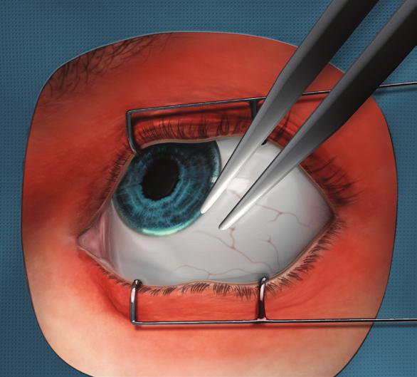 uk/wp-content/uploads/2015/01/2009-sci-012_guidelines_for_intravitreal_injections_procedure_1.pdf.