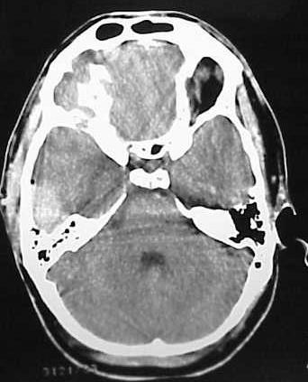 Reaktinsgrad Patient A Epiduralhematom