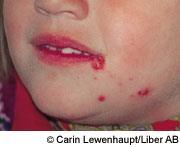 Sår Barnet ska vara hemma: Vid infekterande sår eller eksem som är vätskande. Till exempel impetigo (svinkoppor) eller nagelbandsinfektioner.