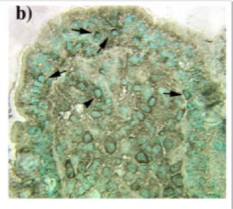 2018-11-01 DET PRODUCERAS INFLAMMATORISKA SIGNALSUBSTANSER AV TARMENS T-CELLER VID AKTIV CELIAKI aktiv CD, jejunum färgad för immunceller