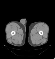 från fettfri massa CT/MR DXA Bioimpedans (?) Antropometri?