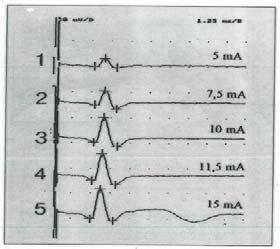 EEG metodik 12. Ange fyra indikationer till EEG. 2p 13. Beskriv utförligt metoden för ett rutin EEG på en vuxen patient (antal elektroder, provokationer etc.). 4p 14a.