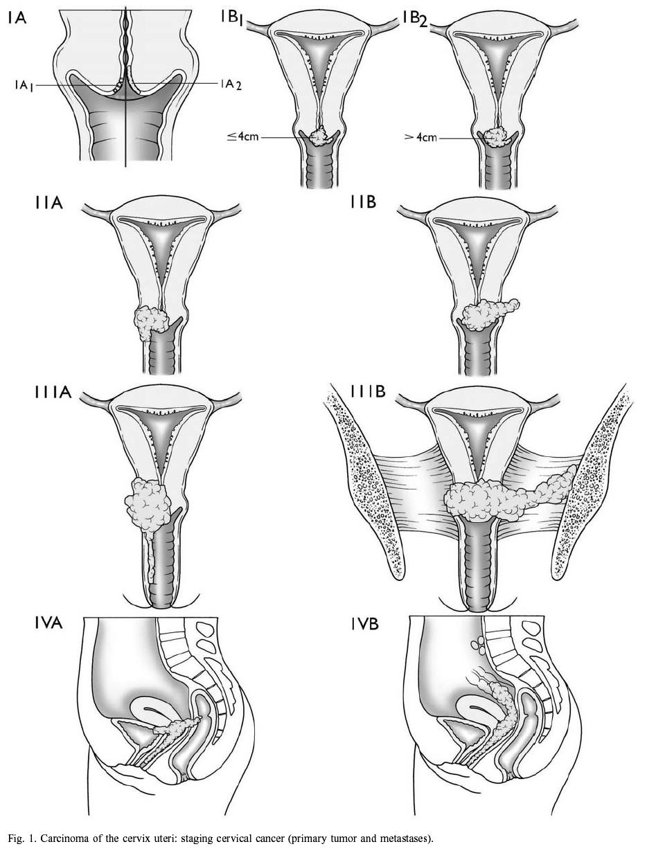 Behandling cervixcancer Primär kirurgi Tumör < 4cm utan parametrieinfiltration, lymfkörtelmetastaser Definitiv