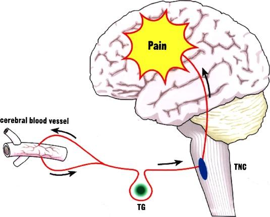 Migrän är ärftligt Patofysiologi Migränhjärnan är hyperexcitabel Migrän är en neurovaskulär sjukdom Fysisk aktivitet vid migrän