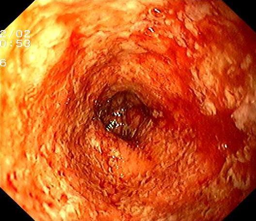 Normal colon Ulcerös Kolit Utsuddad kärlteckning Spontanblödning Diffus