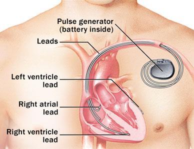 CRT Cardiac Resyncronisation Therapy NYHA (II)III-IV trots fullgod