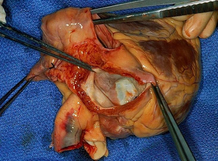 Hjärttransplantation Terminal hjärtsvikt NYHA III-IV Ingen annan medicinsk eller kirurgisk behandling att tillgå Inga