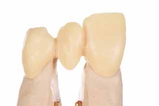 Om för mycket dentin (kerammaterial) har tagits bort kan detta rättas till genom applicering av dentinmassa innan emalj