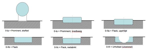 4/5 För behandling med RFA ställs remiss till Matstrupslab, Kirurgmottagningen på ViN Norrköping. Radiofrekvensablation återställer skivepitelet i BE med SIM, LGD och HGD.