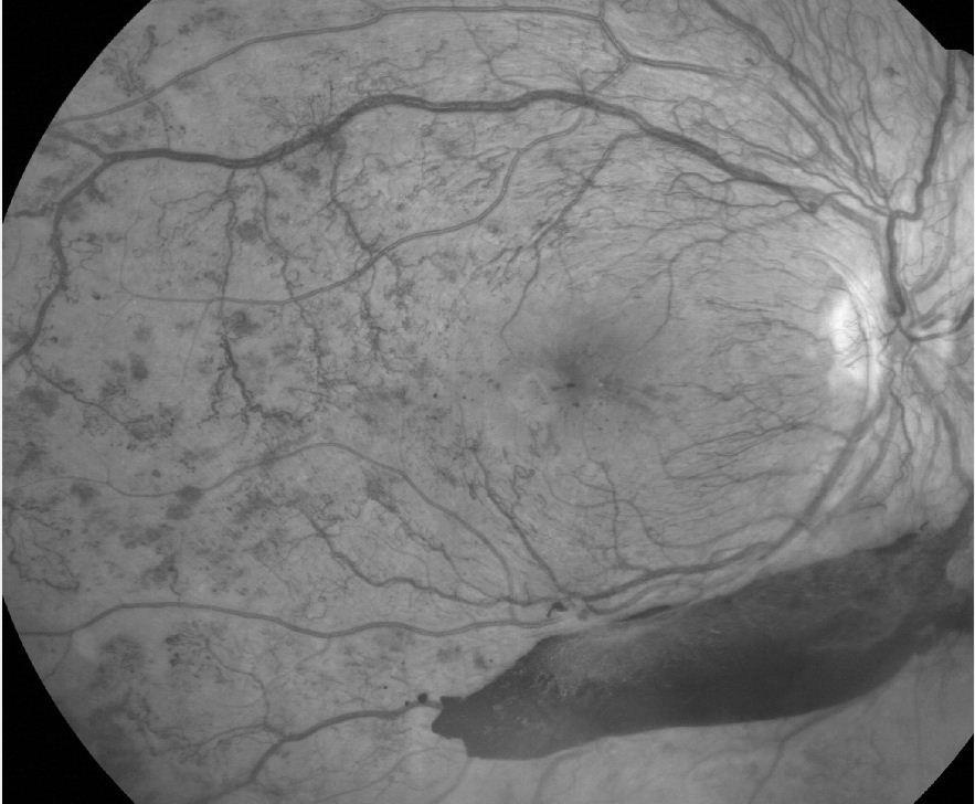 140905 Medicinsk retina Diabetesretinopati Vanligaste orsaken till blindhet hos patienter i 20-64 års ålder. Förekommer hos upp till 80 % av diabetiker med diabetesduration > 10 år.