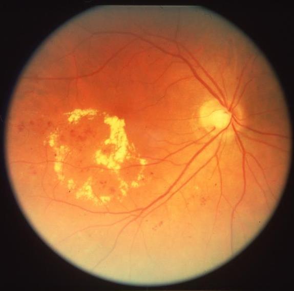 Maculaödem Innebär en ansamling av vätska som leder till svullnad av retina pga kronisk hyperglykemi. Drabbar 10 % av alla diabetiker, framförallt typ I (dubbelt så vanligt).