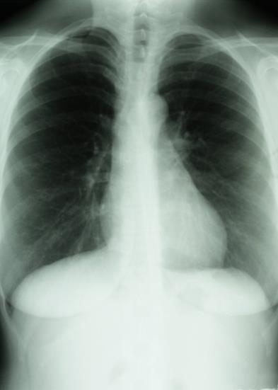 Lungröntgen Barn och ungdomar under 18 år: Gäller alla barn under 5 år från länder med hög risk för tuberkulos Barn över 5 år och ungdomar om PPD 6 mm Vuxna över 18 år: Om PPD 10 mm