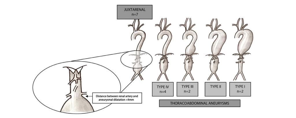 Juxtarenalt bukaorta aneurysm Avstånd mellan njurartär och aneurysmatisk vidgning < 4 mm Thorako-abdominella aorta aneurysm Den postoperativa mortaliteten efter öppen operation för aortaaneurysm