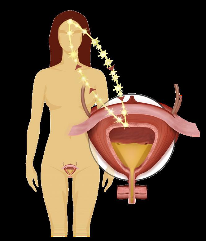 Vad är orsaken till neurogen överaktiv blåsa? Neurogen överaktiv blåsa är ett tillstånd som kan ställa till stora besvär i vardagen.