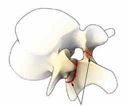 L5-bågen Spondylolys Fraktur i