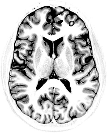 BROSCHYREN NEURO-Klinmed V, start VT 2011 Välkommen till neuroplaceringen!