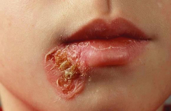 Impetigo - behandling Peroral antibiotika Altargo, salva hur länge till?