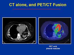 2016:88 PET/CT inför strålbehandling/lungcancer Att utvärdera om kombinationen av PET och CT är bättre än enbart CT avseende bestämning av tumörvolymer och strålfält för behandling hos patienter med