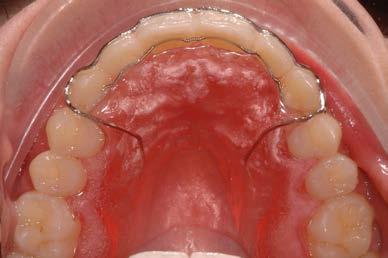 Det vetenskapliga underlaget är otillräckligt (GRADE ) avseende huruvida det finns någon skillnad mellan olika typer av retainer avseende sidoeffekter på tänderna i form av skador på tandens fäste