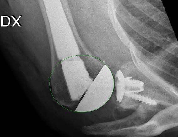 2012:52 Skulderledsprotes vid artros F örbättras funktion och livskvalitet hos patienter med skulderledsartros av efter operation med insättning av en skulderledsprotes?