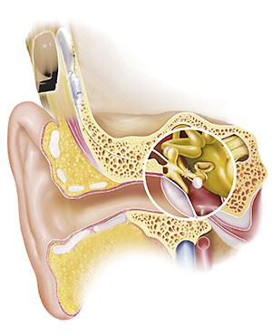 2011:42 Benförankrad hörapparat Ä r ett benförankrat hörselhjälpsystem ett bättre hjälpmedel än kontralateral ljudöverföring eller inget hörselhjälpmedel alls hos patienter med ensidig dövhet?