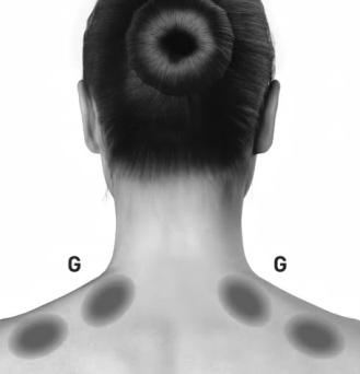 Följande diagram anger rekommenderade muskelgrupper för eventuella ytterligare injektioner: D. Temporalis: 5 E/ställe ( 2 ytterligare ställen) E. Occipitalis: 5 E/ställe ( 2 ytterligare ställen) G.