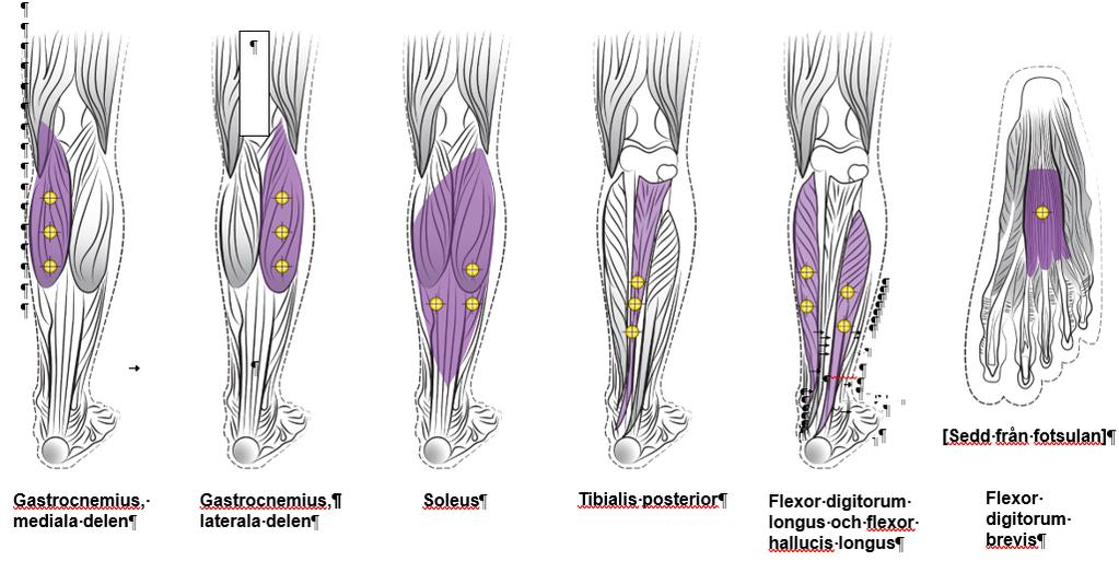 Fokal spasticitet i nedre extremiteten i samband med stroke muskeltonus hade avtagit. Dessa patienter erhöll upp till fyra injektioner med en maximal kumulativ dos på 960 enheter under 54 veckor.