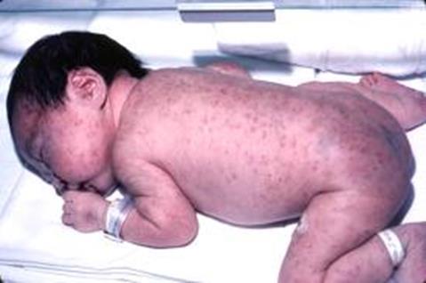 Pojke 3 dagar gammal Kvinna med ledgångsreumatism (RA) Normal förlossning