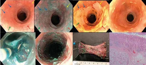 Figur 4. Endoskopiska fynd och endoskopisk submukosadissektion vid skivepitelneoplasi i matstrupe. A. Med vitt ljus noterades en rodnad och diskret flack lesion som omfattade hela cirkumferensen. B.