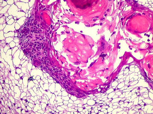 8-12åå > Suprasellär Histologi Epiteliala celler Cystor
