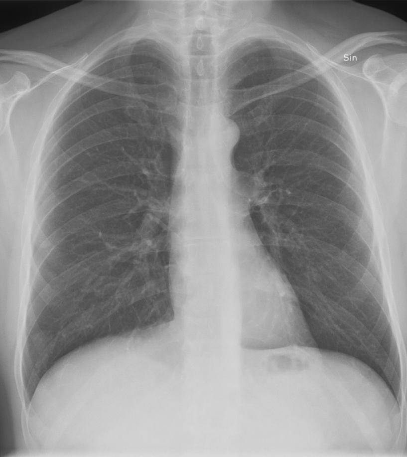 Lungröntgen + Lätt att utföra + Låg dos 0.05-0.