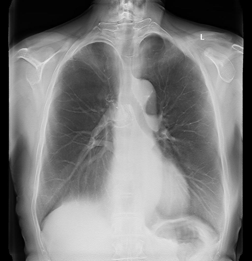 Postop bronchial stenos